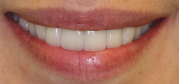 after procelain dental veneers